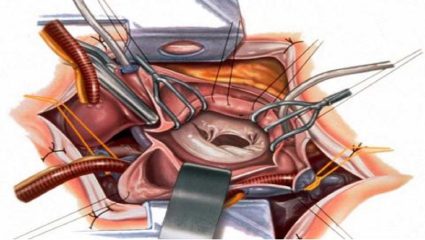 Medical Success Story: 20 वर्षीय तरुणीवर वॉकहार्टमध्ये यशस्वी मिनिमली इन्व्हेसिव्ह माइट्रल व्हॉल्व्ह रिप्लेसमेंट शस्त्रक्रिया