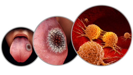Oral Cancer: वेळीच निदान झाल्यास मौखिक कर्करोग होईल पूर्ण बरा; सुरुवातीच्या लक्षणांकडे दुर्लक्ष न करण्याचा तज्ज्ञांचा सल्ला