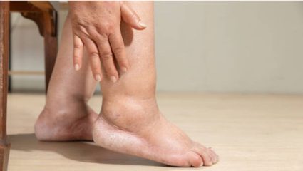 Health Tips : पायांना वारंवार सूज येतेय? दुर्लक्ष करू नका; ‘या’ गंभीर आजारांचे असू शकते लक्षण