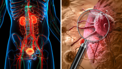 Prostate Cancer: लघ्वी वा Sperm मधून येत असेल रक्त, वेळीच व्हा सावध! प्रोस्टेट कॅन्सरचे असू शकते लक्षण, कारणं आणि उपाय