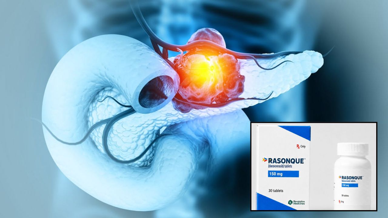 Cancer Cure: कॅन्सर रुग्णांसाठी सर्वात दिलासादायक बातमी; स्वादुपिंडाच्या कर्करोगावर गुणकारी ‘रासॉन्क’ गोळीला अमेरिकन FDA ची मंजुरी