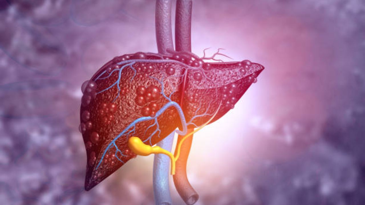 दारू न पिणाऱ्यांमध्ये का वाढत आहे Liver Cancer चा धोका? जीवनशैलीत केलेल्या ‘या’ बदलांमुळे लिव्हरवरील चरबी होईल नष्ट
