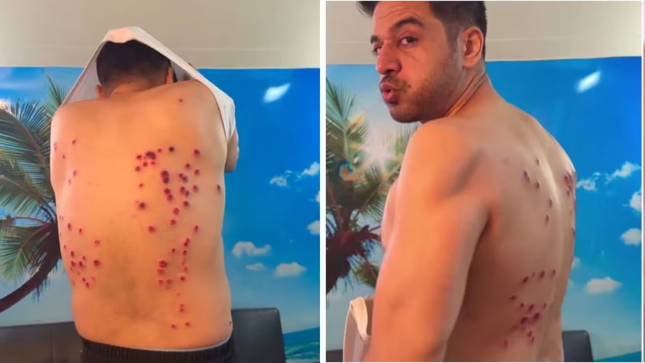 Gaurav Khanna Viral Photos: रबर बुलेट लागून गौरव खन्ना जखमी; ‘खतरों के खिलाडी 15’मधील स्टंटवर नेटकऱ्यांचा संताप