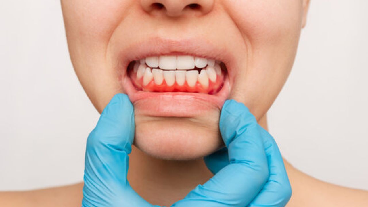 Gums Health: ब्रश करताना हिरड्यांतून रक्त येतंय? जाणून घ्या त्यामागची गंभीर कारणे
