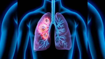 Health News: घरात पडली अन् CT स्कॅनमध्ये धक्कादायक सत्य समोर आलं; 72 वर्षीय महिलेच्या फुफ्फुसाचा कर्करोग मेंदूपर्यंत पोहोचला