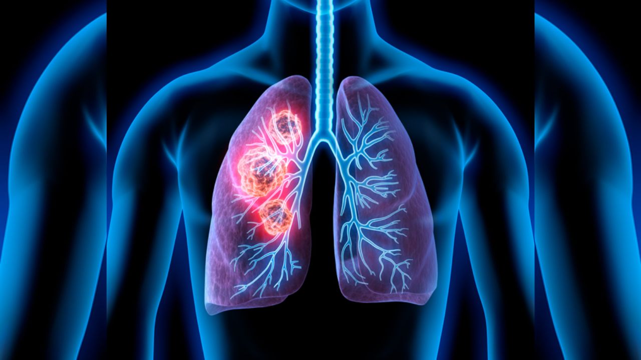 Health News: घरात पडली अन् CT स्कॅनमध्ये धक्कादायक सत्य समोर आलं; 72 वर्षीय महिलेच्या फुफ्फुसाचा कर्करोग मेंदूपर्यंत पोहोचला