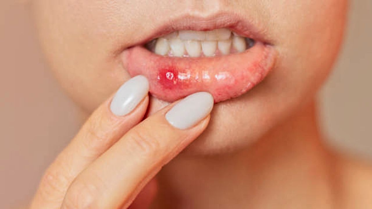 Mouth Ulcer: वारंवार तोंड येतेय का? दुर्लक्ष करू नका; ‘या’ ५ गंभीर आजारांचे असू शकतात संकेत