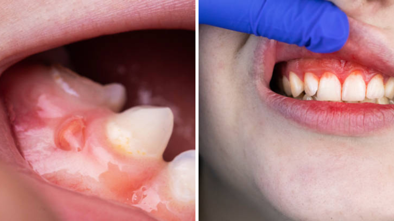 Teeth Infection: अक्कल दाढेचा त्रास की हिरड्यांमधील इन्फेक्शन? चावताना वेदना होत असतील, वेळीच ओळखा संकेत