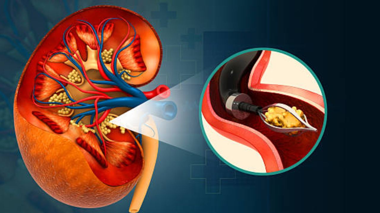 Kidney Health: जेवणातील ‘या’ पदार्थांच्या सेवनामुळे वाढतो किडनीच्या आजारांचा धोका, मुतखडा होऊन उद्भवू शकतात गंभीर समस्या