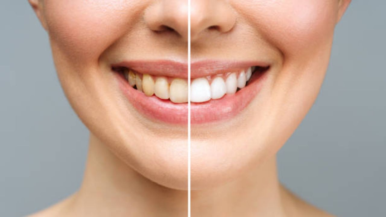 Teeth Care Tips: ब्रश करून सुद्धा दात पिवळेच दिसतात? मग लिंबाच्या रसात मिक्स करा ‘हा’ पदार्थ, दातांवर येईल मोत्यासारखी चमक