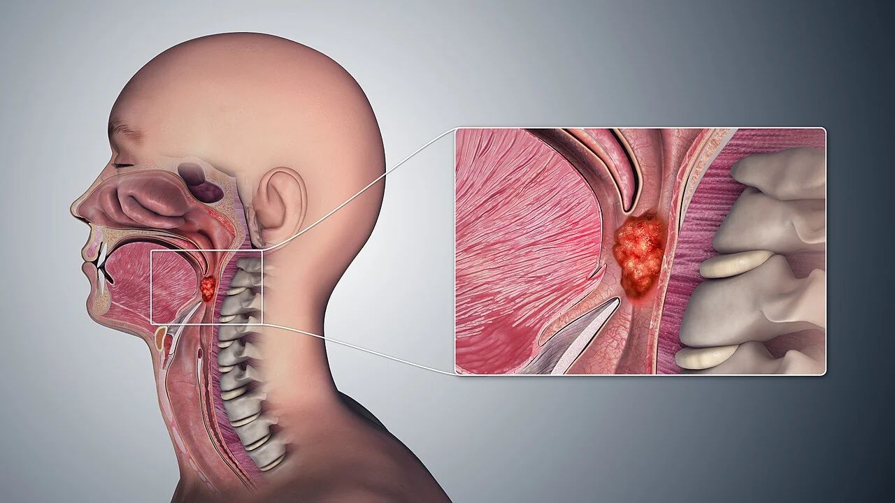 Early Throat Cancer: ६८ वर्षीय रुग्णाला दुर्मिळ कर्करोगाचे निदान; आधुनिक शस्त्रक्रियेतून मिळाला दिलासा