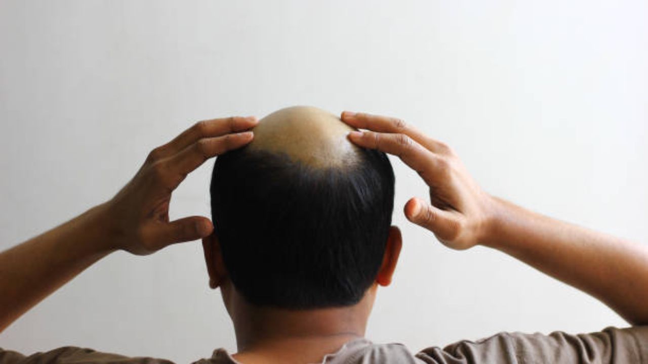 Hair Care Tips: समोरुन टक्कल पडून हेअरलाईन मागे गेली आहे? केस विरळ होण्याची ‘ही’ आहेत कारण, दुर्लक्ष केल्यास केसांचे होईल नुकसान