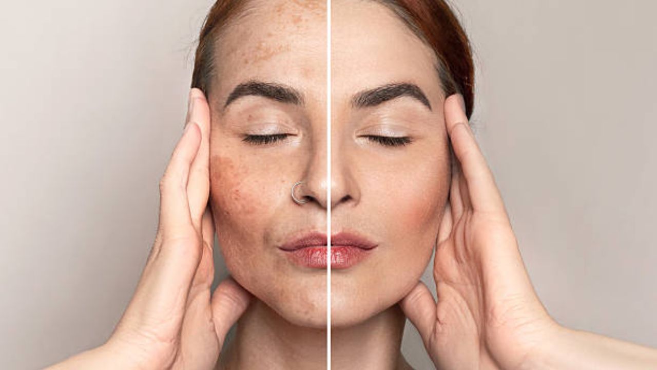 Skin Care Tips: पिगमेंटेशनमुळे चेहरा खराब झाला आहे? मग ‘या’ पद्धतीने चेहऱ्याला लावा लसूण, त्वचा होईल उजळदार