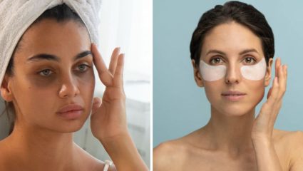 Dark Circles: डार्क सर्कल्समुळे हैराण झाला आहात? जाणून घ्या डोळ्याखाली काळी वर्तुळे येण्यामागील कारणे आणि त्यावरील घरगुती उपाय