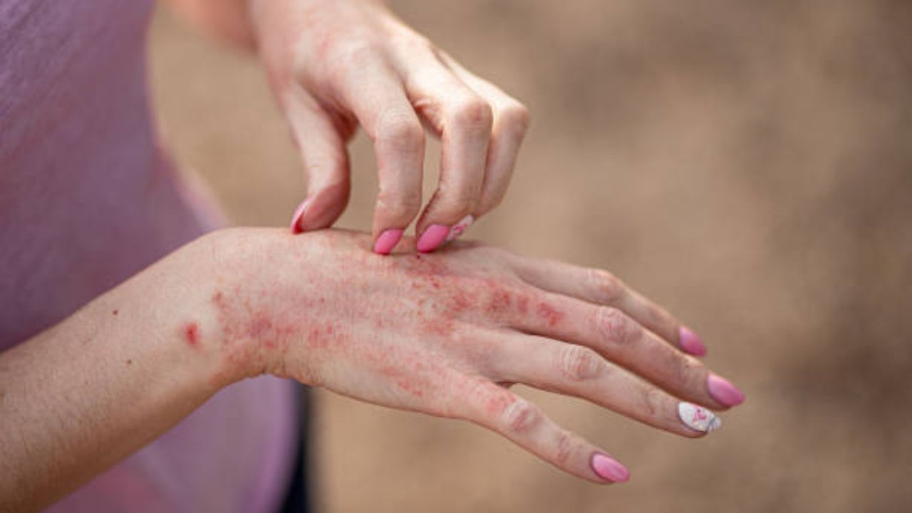 Skin Infection: त्वचेवर लालसरपणा आणि सूज दिसल्यास व्हा सावध! जाणून घ्या संसर्गाची गंभीर लक्षणे