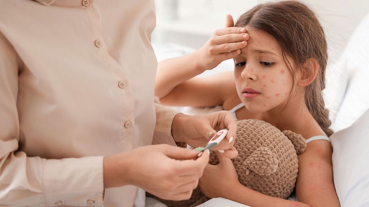 Childrens Health Tips:  ताप, खाज आणि अंगावर फोड! कांजिण्यांची लक्षणं दिसताच पालकांनी काय करावं? जाणून घ्या महत्त्वाच्या गोष्टी